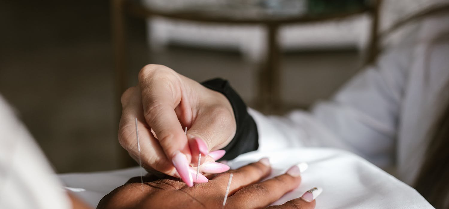 Practitioner inserting acupuncture needles on patient's hand